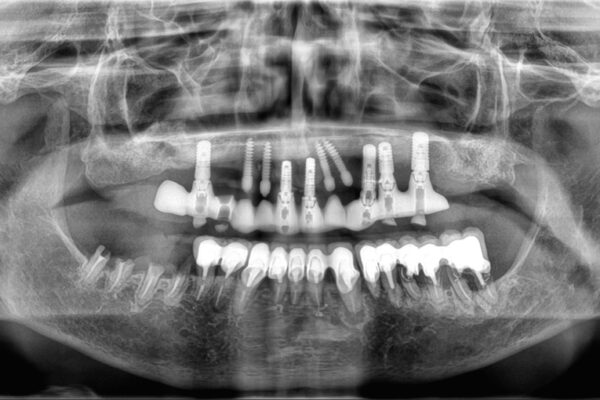 TOMOGRAFO DENTAL CARESTREAM CS 8200 3D - Imagen 4
